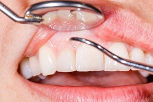 Zahnfleischbehandlung (Parodontologie)